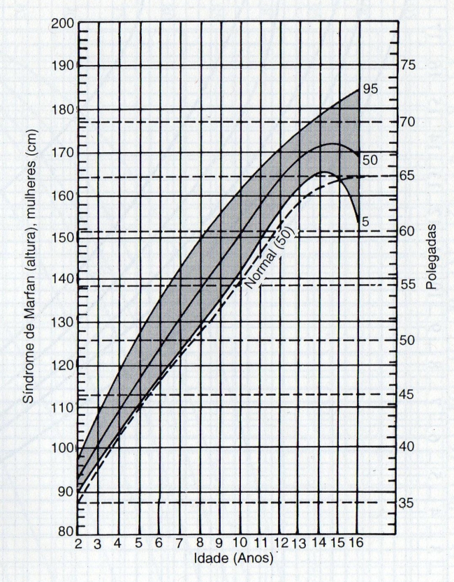 CURVA DE CRESCIMENTO ESTATURAL - SÍNDROME DE MARFAN - FEMININO